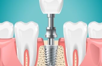 Dental Implants in Dumfries